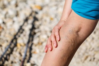 Varicose-Veins.jpg