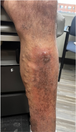 man's leg with phlebitis