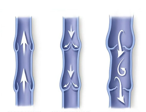 Illustration of valves in veins that show how blood flows and when valves fail.