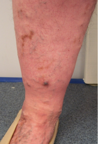 72 year old woman with recent rupture and bleeding on her leg
