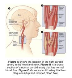 Carotid Artery Disease The Cardio Vascular Care Group