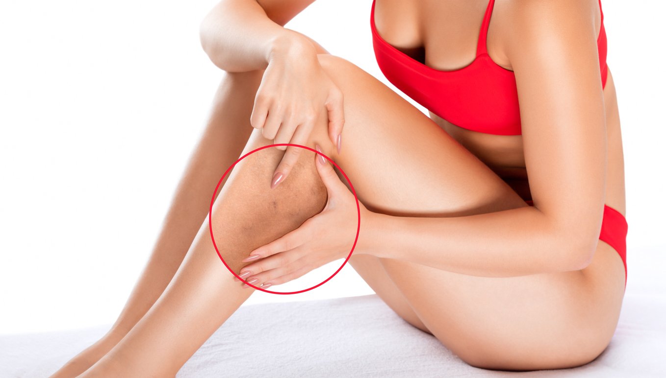Woman in red bathing suit caressing her legs that have spider veins
