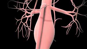 What You Should Know About Aortic Aneurysms