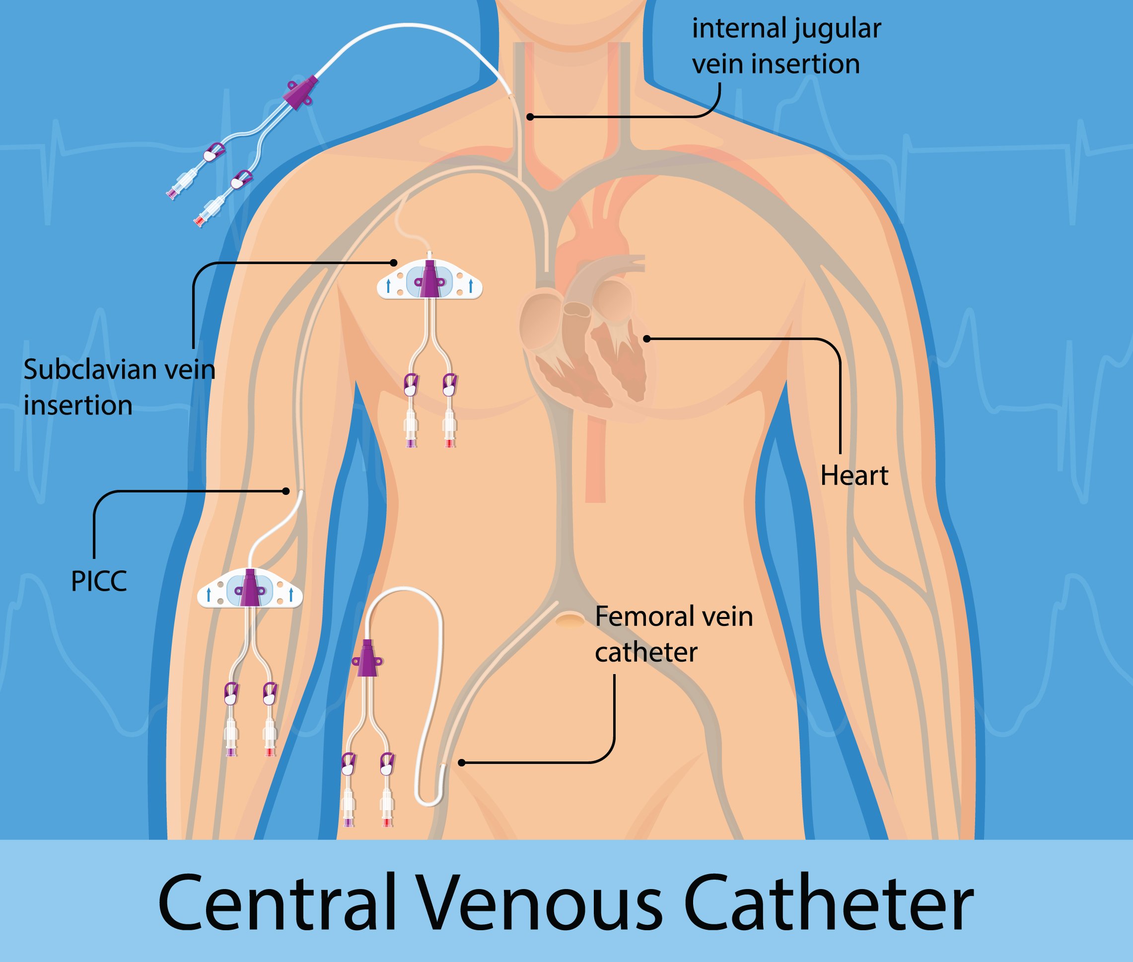 Central Venous Catheter