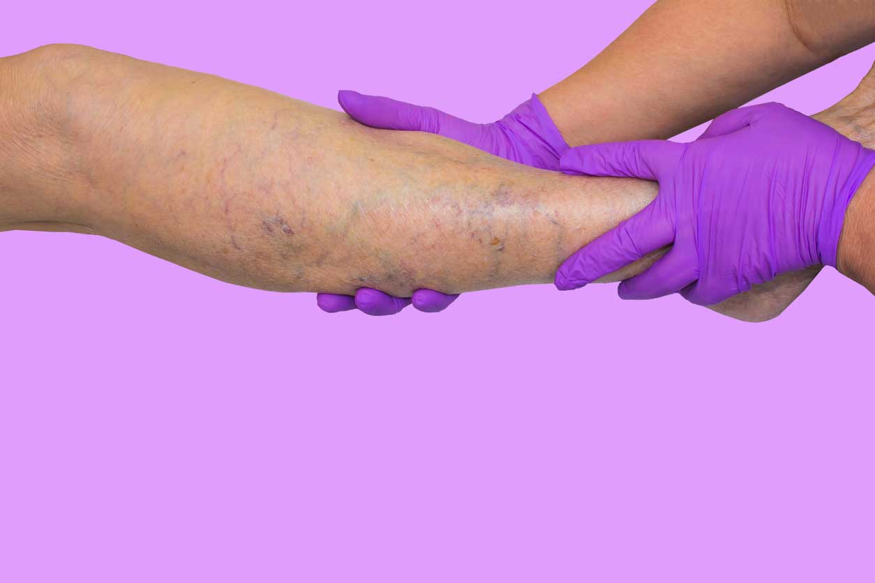 Lymphedema vs. Chronic Venous Insufficiency (CVI): Meaning, Differences & Treatment