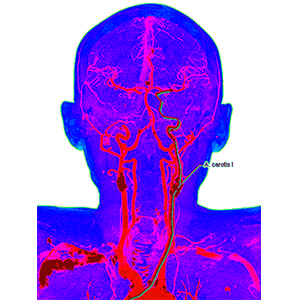 carotid artery brain prognosis