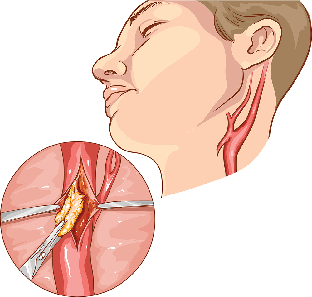 What is a Carotid Endarterectomy?