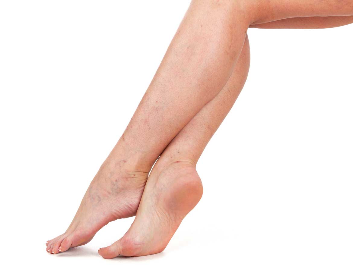 An Overview of Leg Discoloration and Preventive Measures