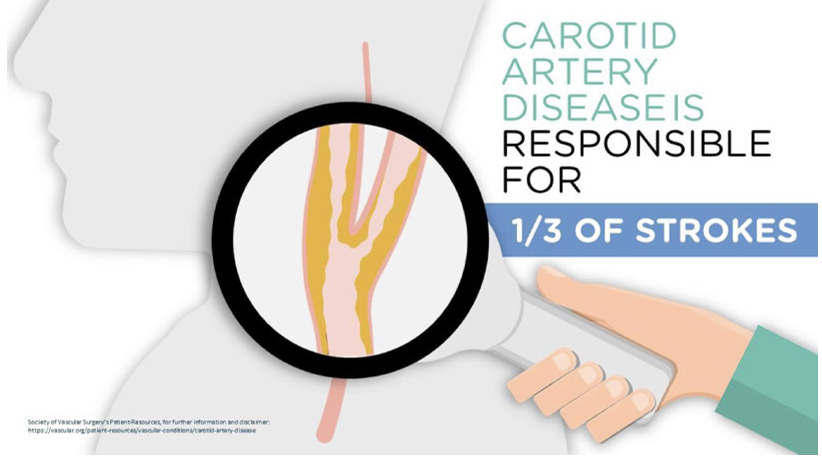 Carotid Artery Disease