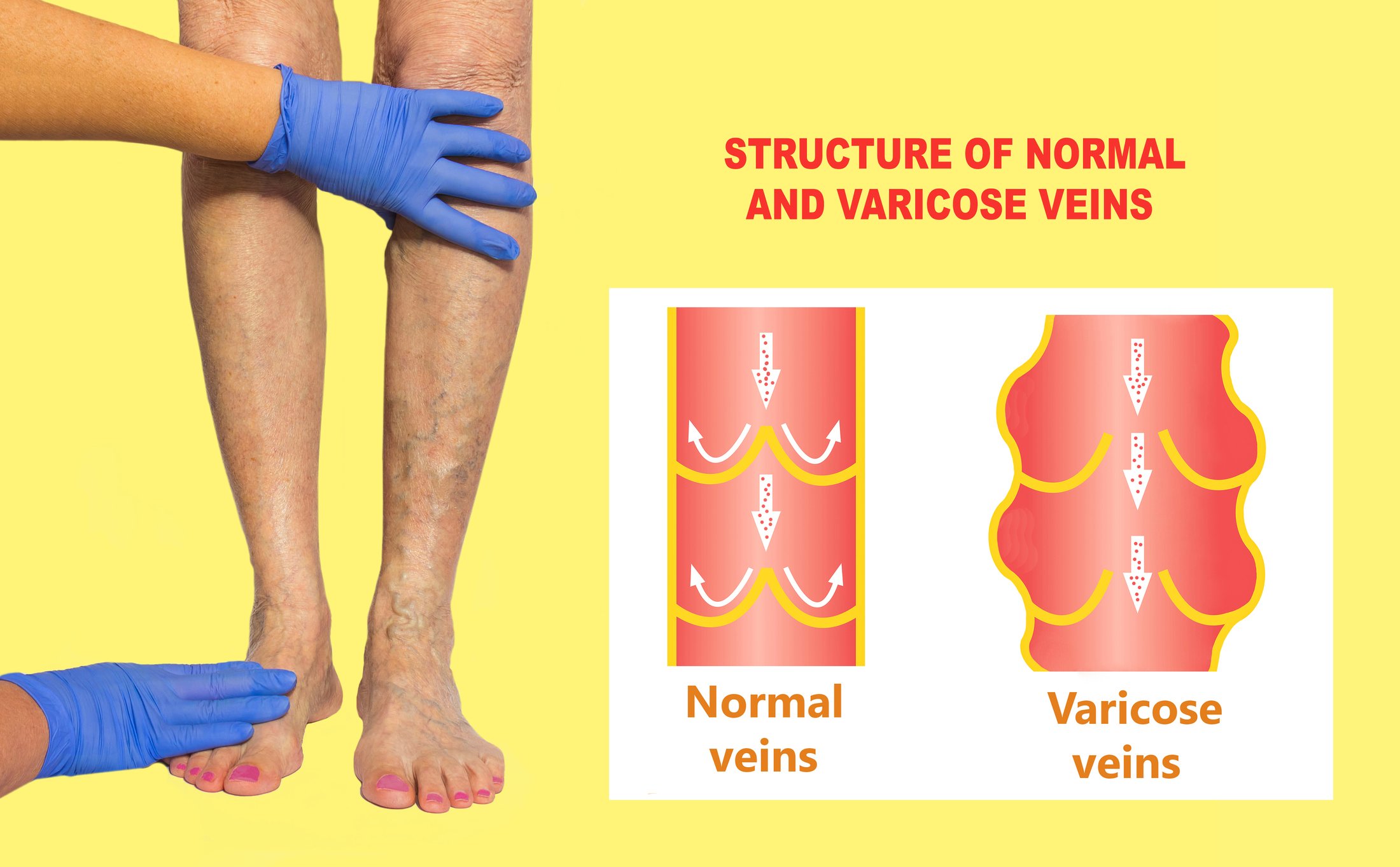 The varicose veins on female legs on colored background