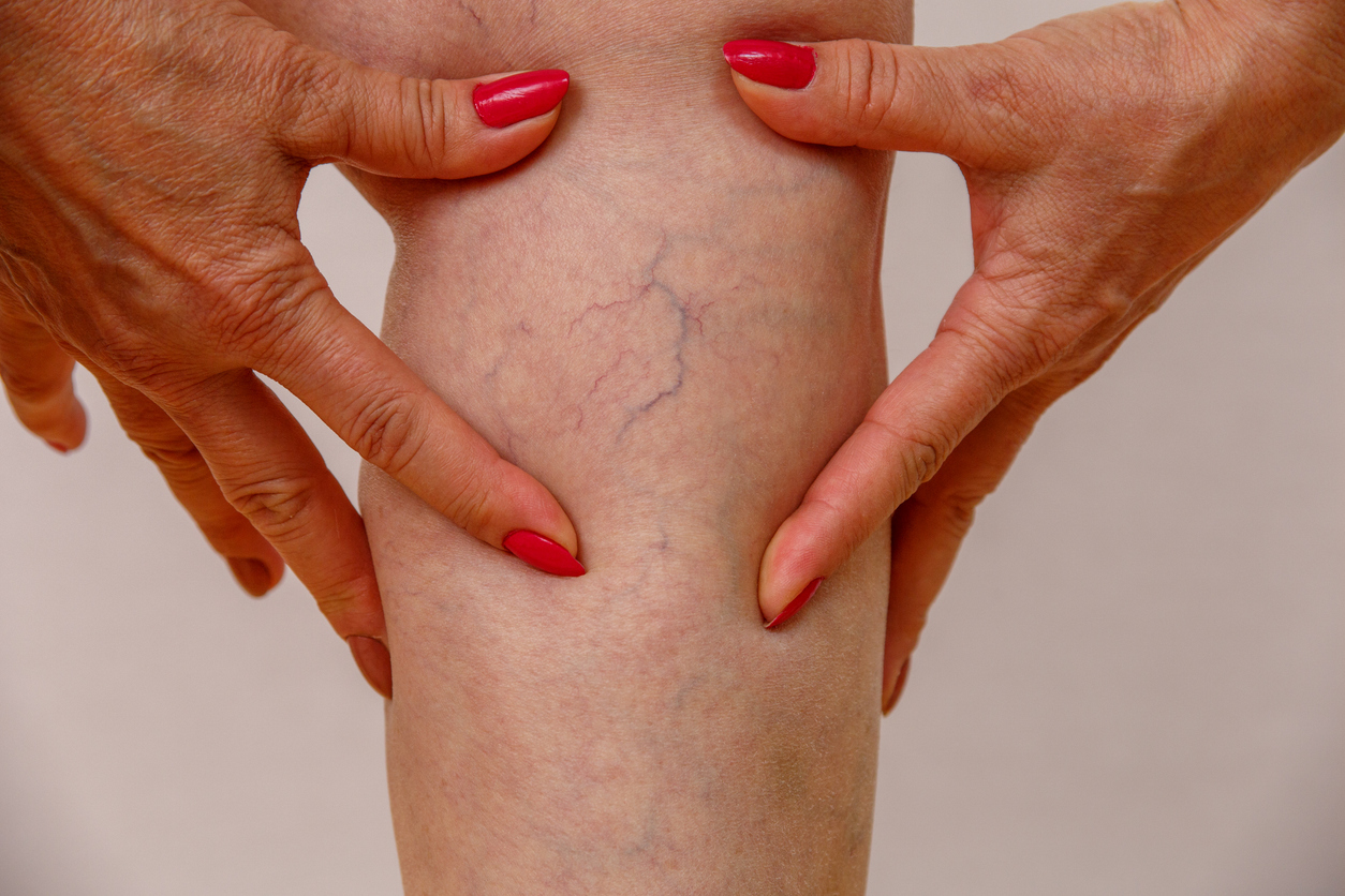 elderly women with varicose veins