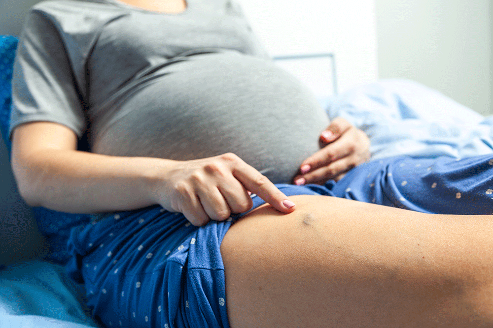 Here’s What You Should Know About Varicose Veins and Pregnancy