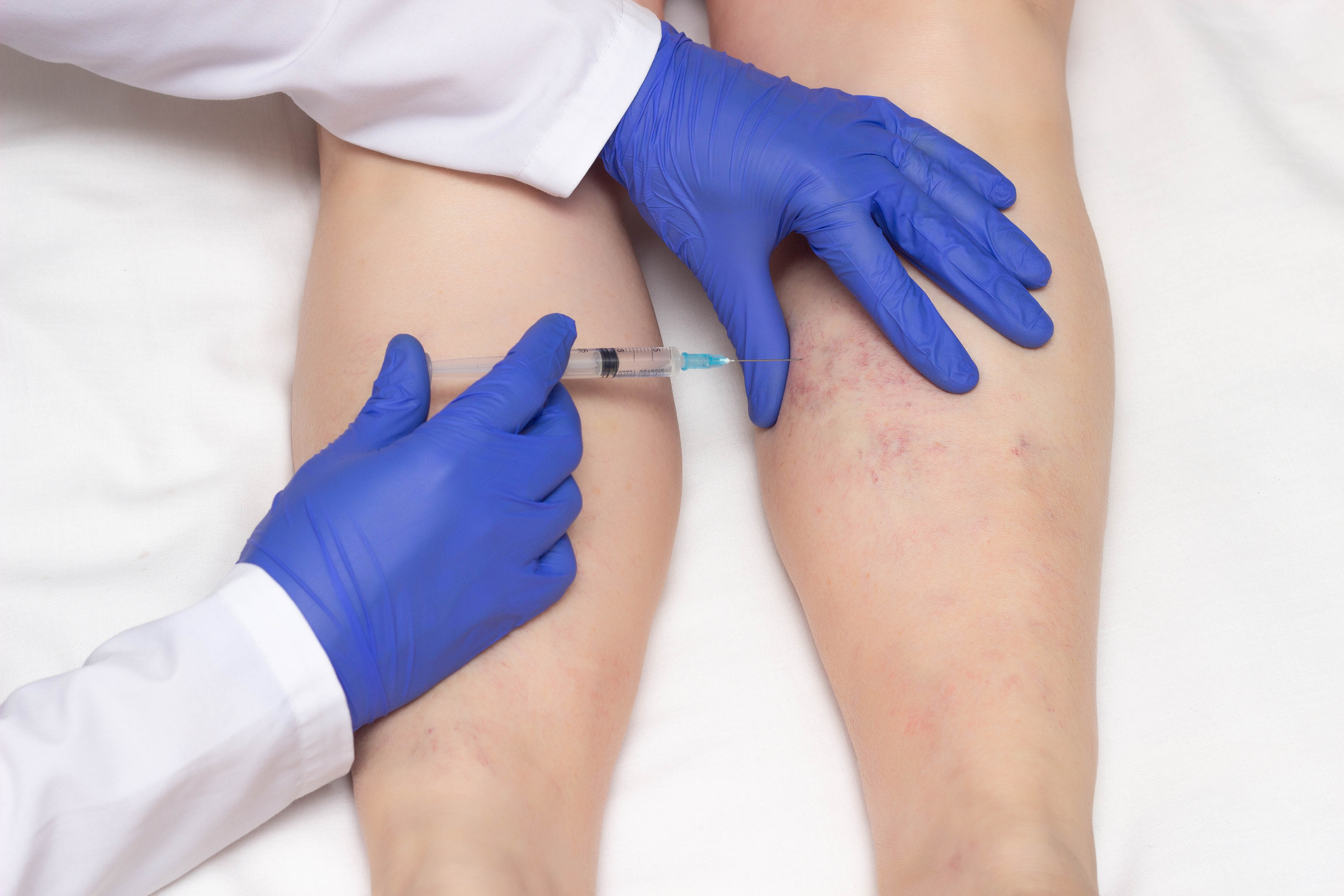 Varithena: A New Approach for Treating Varicose Veins