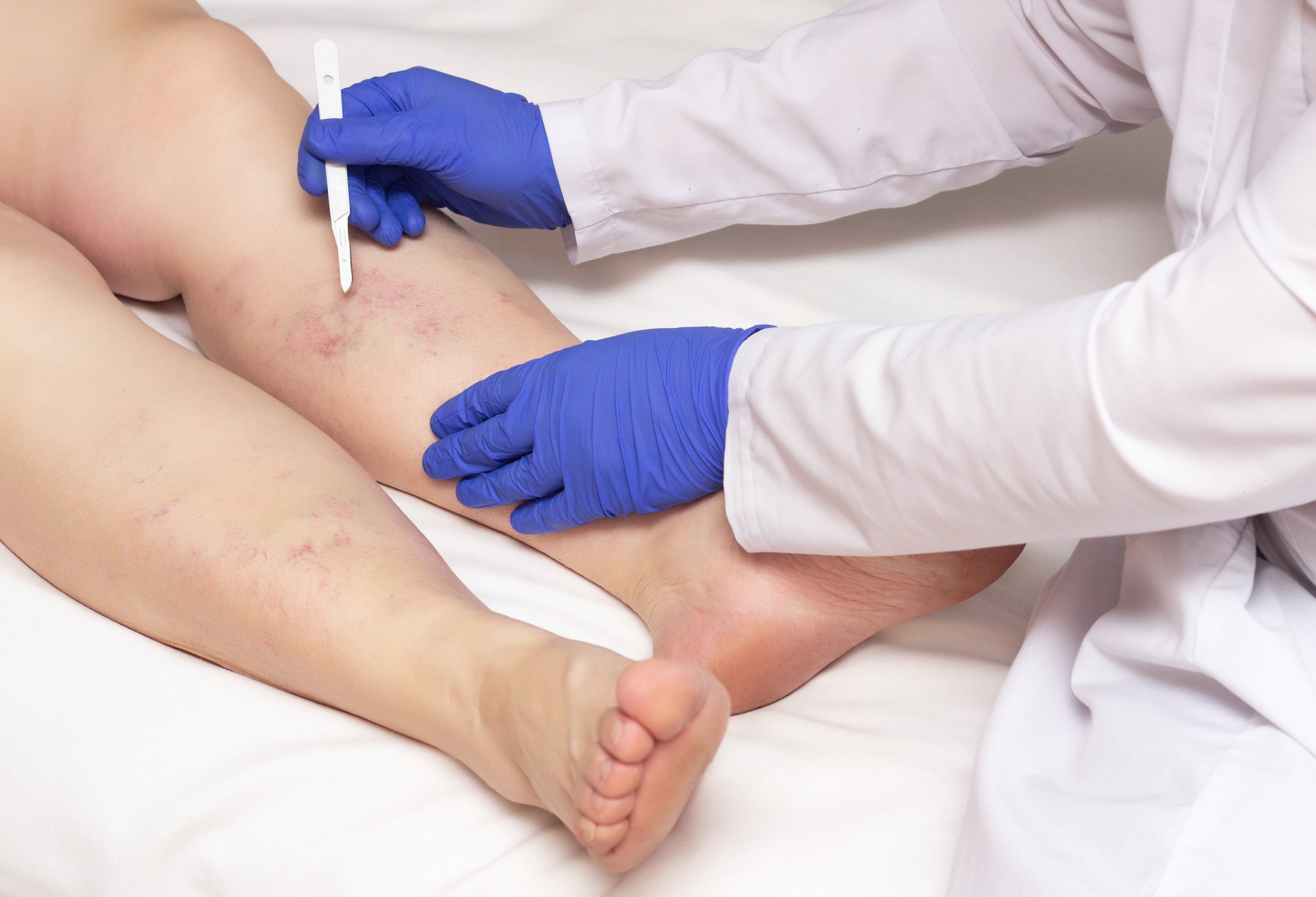 Doctor vascular surgeon holds a scalpel near the legs of a woman with a disease of varicose veins of the lower extremities. The concept of treating varicose veins with surgery, healthcare