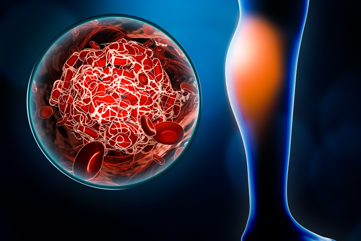 Pulmonary Embolism and Its Relation to Vascular Health