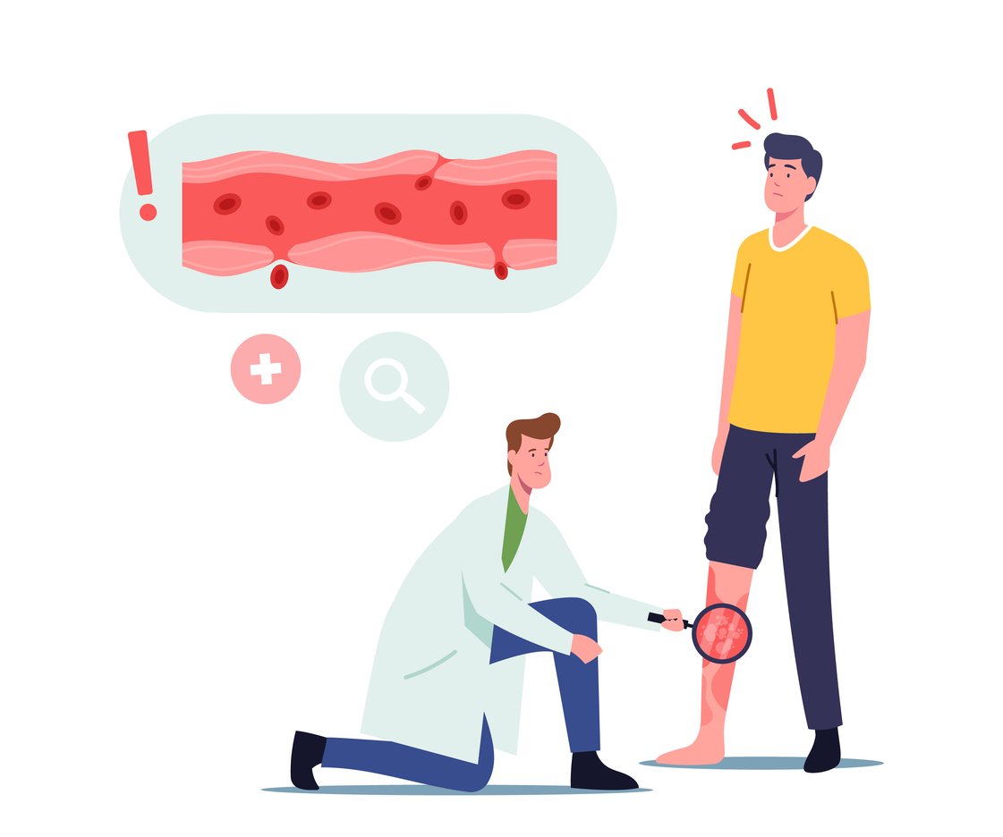 Vessels Inflammation, Rosacea Vasculitis Concept. Doctor Character with Magnifying Glass Looking on Patient Foot with Diseased Inflammated Veins. Health Care, Podiatry. Cartoon Vector Illustration