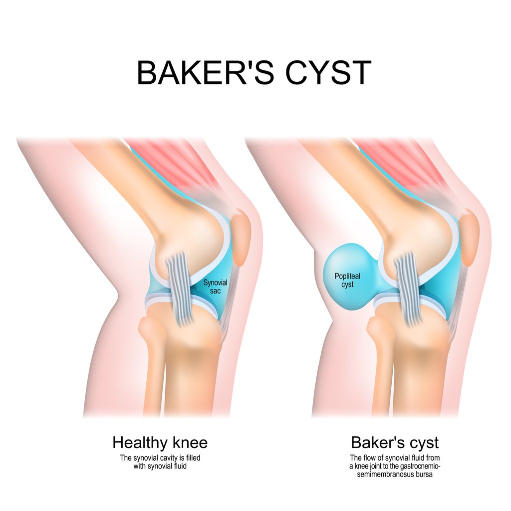 does-a-baker-s-cyst-mean-i-have-vein-issues