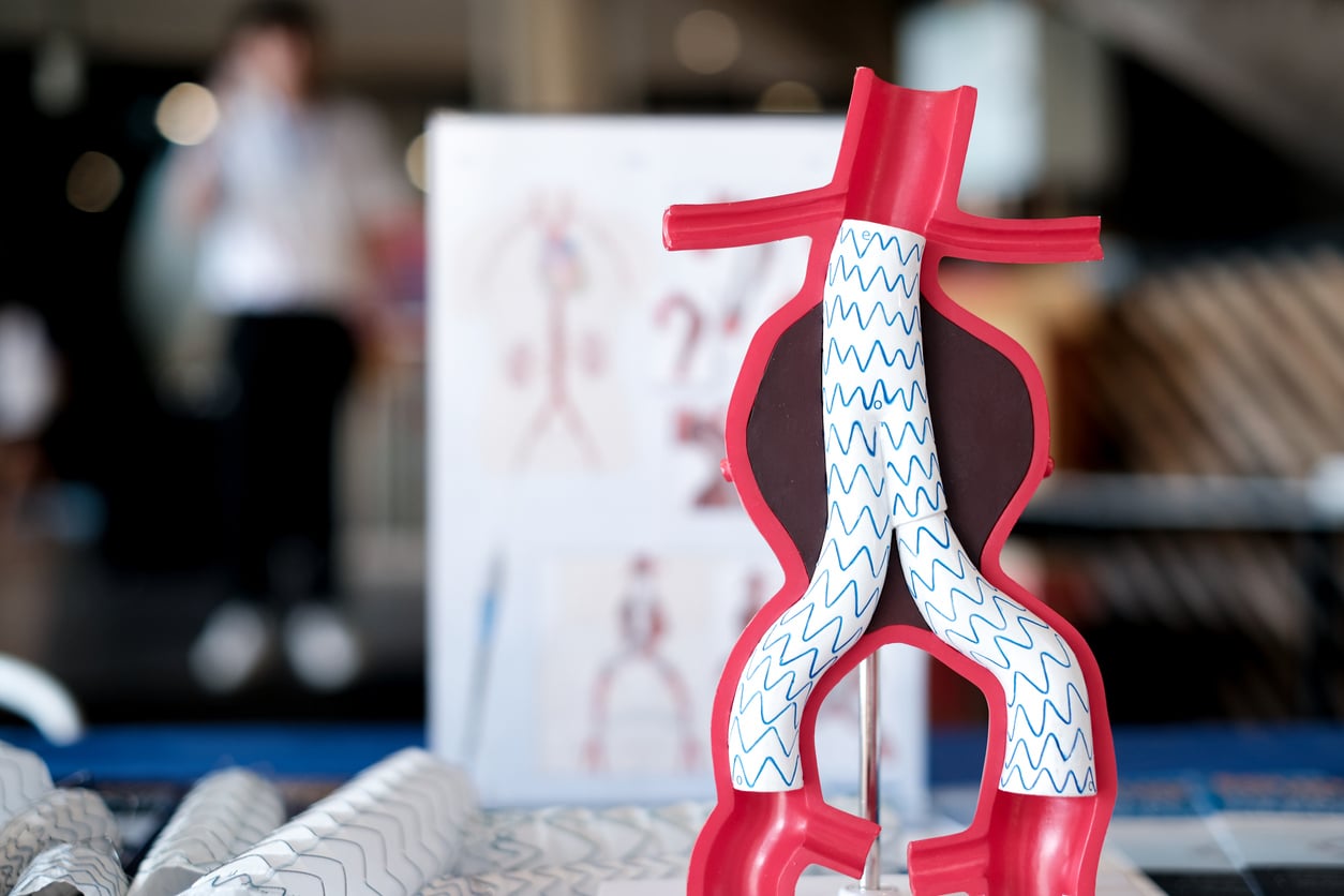 a model of endovascular aneurysm repair (evar) for people education