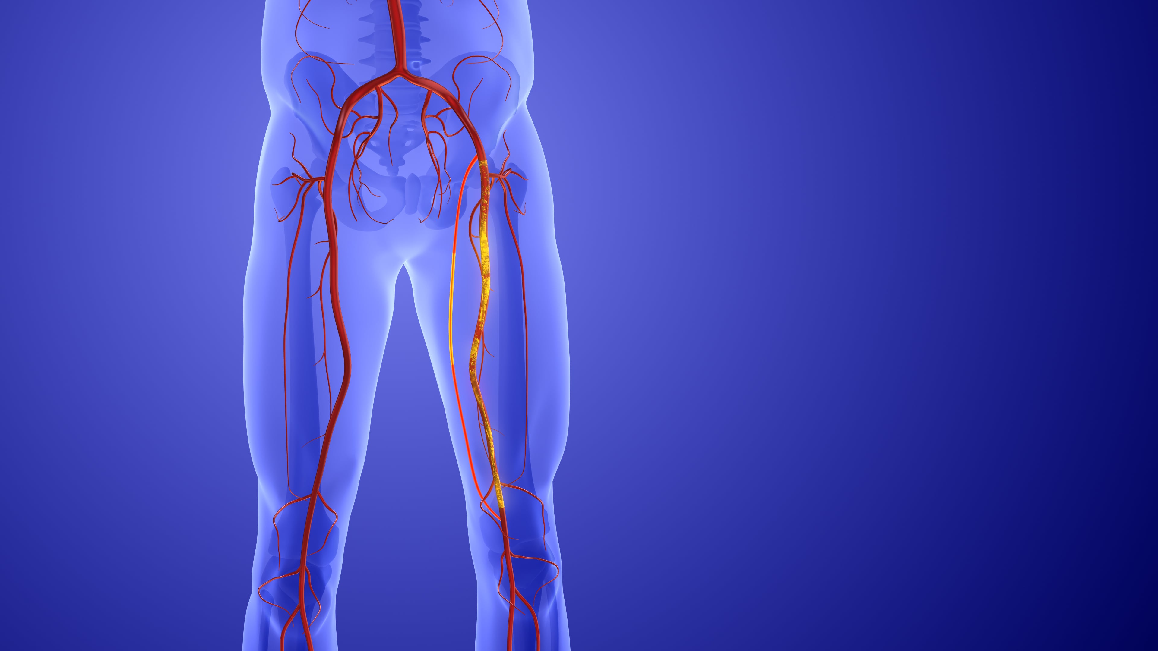 When is a Leg Angiogram Needed?