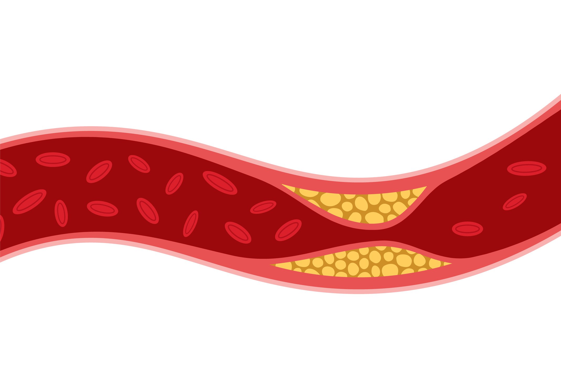 Cholesterol artery thrombosis micro vascular desease. Arteriosclerosis blood vector atherosclerosis risk.