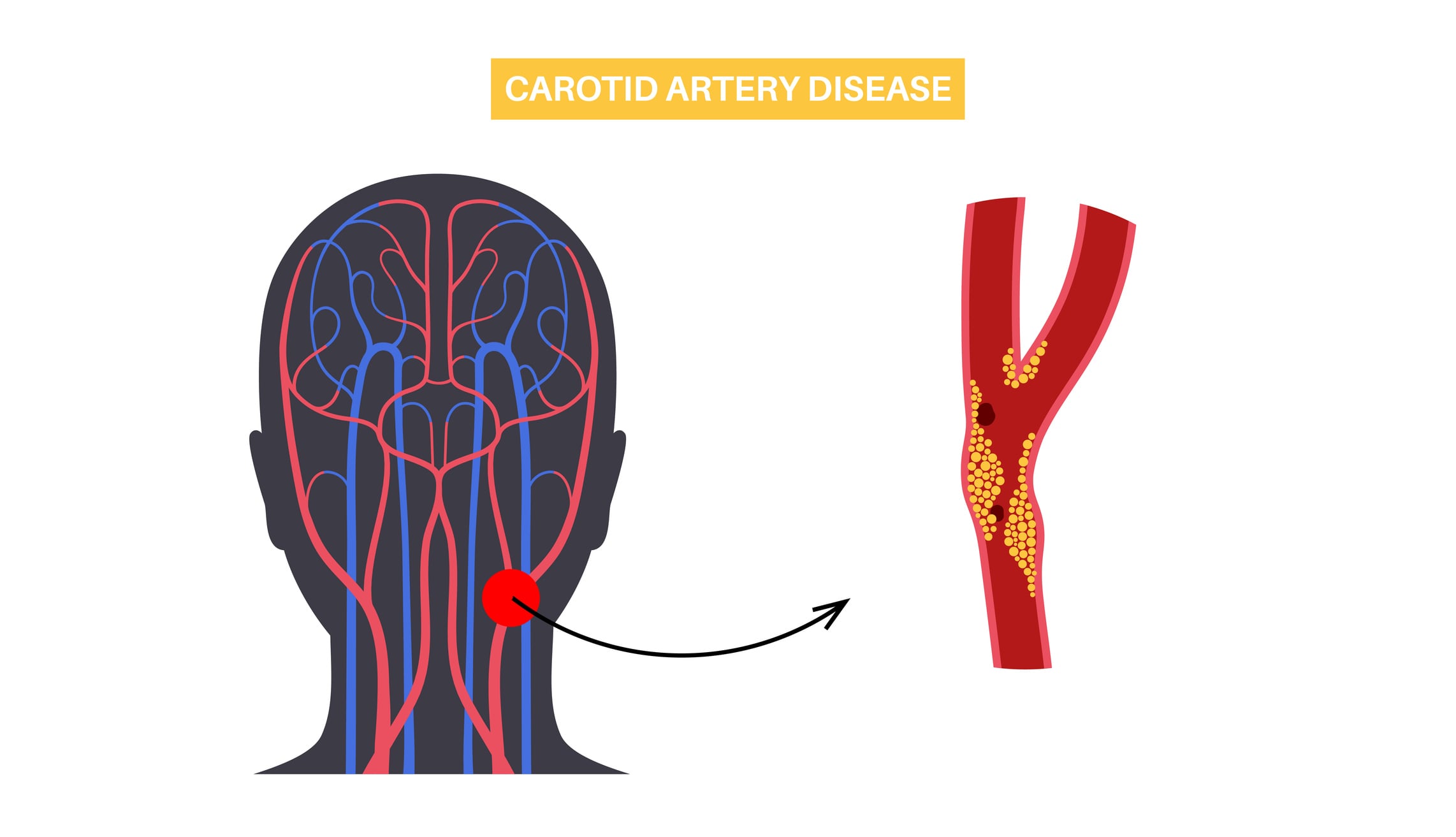What Happens If You Don't Treat Carotid Artery Stenosis?