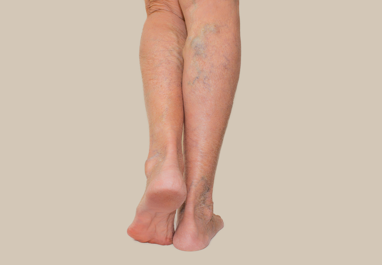 Varicose veins on lower leg