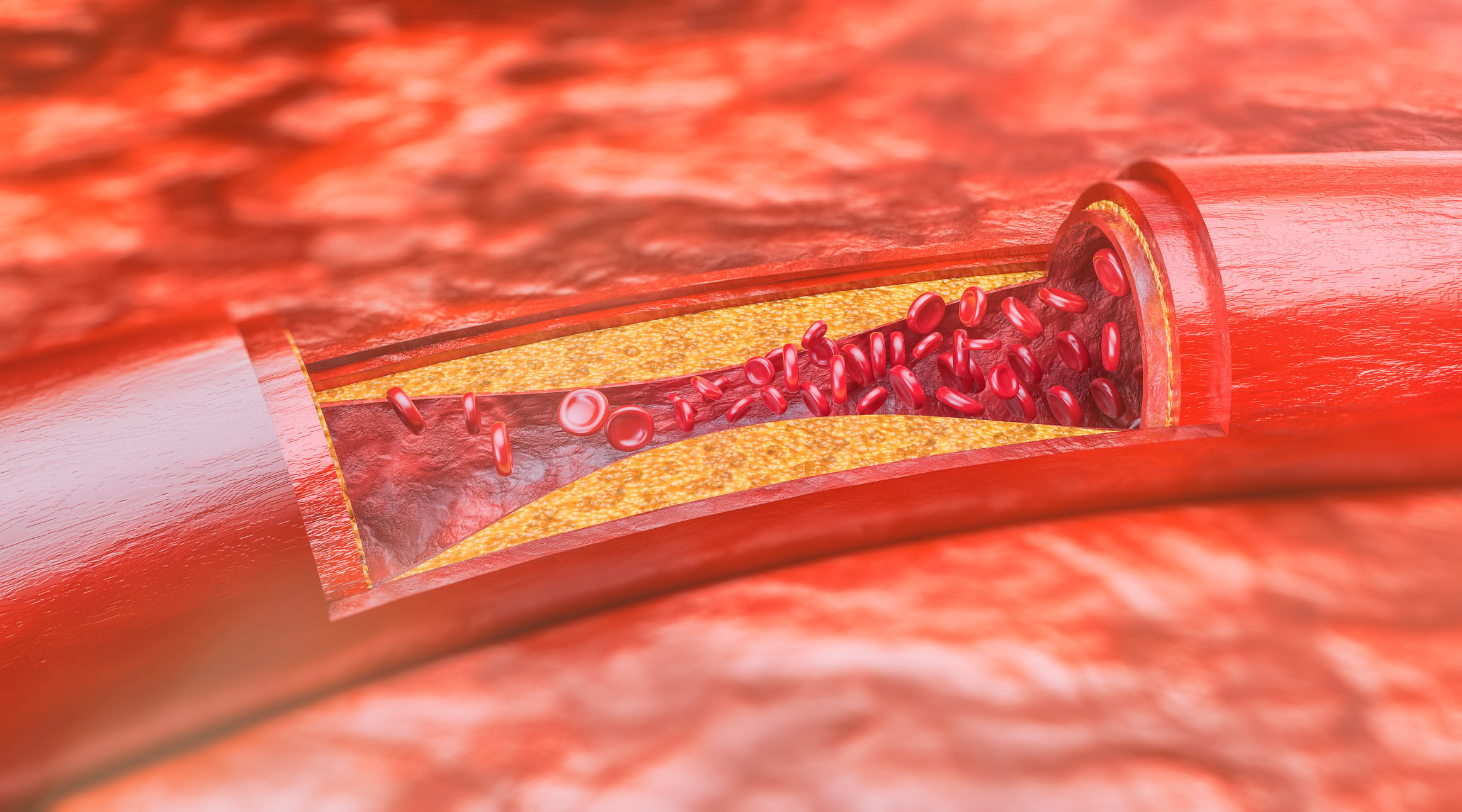 The Dangers of Atherosclerosis: What You Need to Know