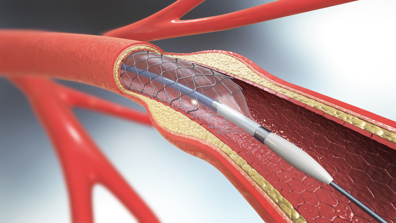 Here's What You Need to Know About Carotid Angioplasty and Stenting